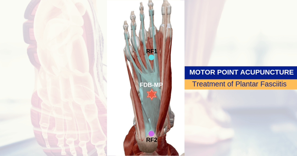 Motor Point Needling Plantar Fasciitis NeedlePro Australia