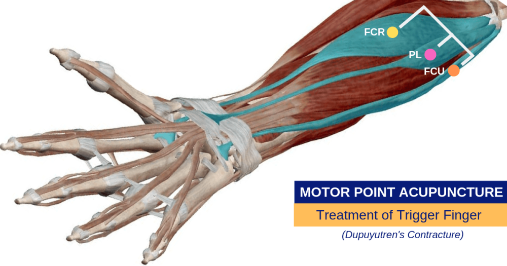 Motor Point Needling Trigger Finger (Dupuytren's Contracture